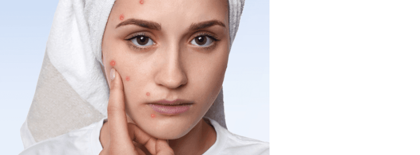 Can a Bad Gut Cause Pimples and Dull Skin?